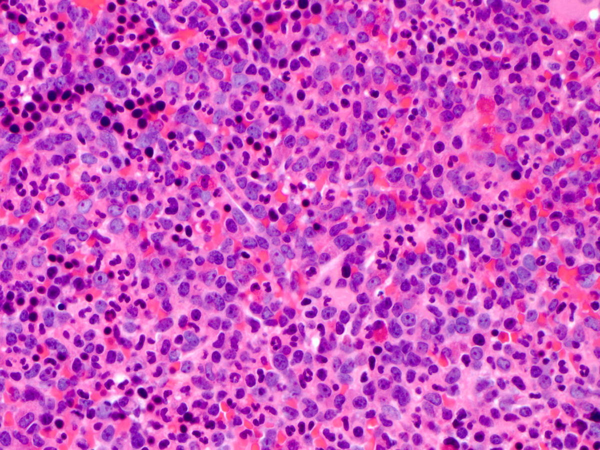 High power view of bone marrow biopsy showing numerous blasts.