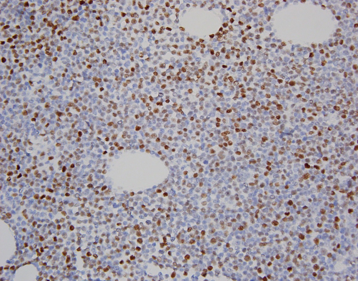 cMYC immunostain demonstrates strong nuclear staining in ~40% of neoplastic cells (400x)