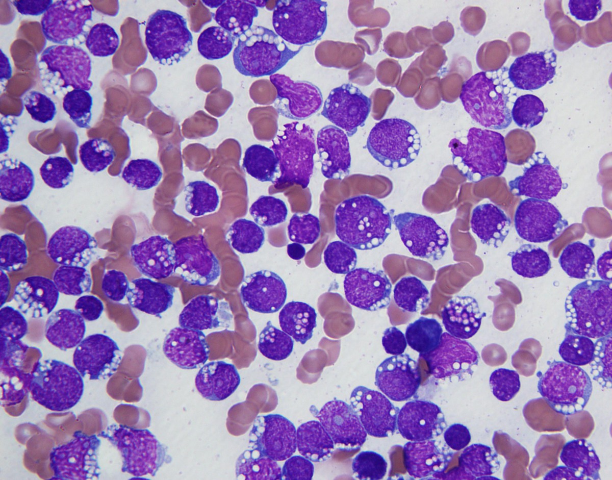 Bone marrow aspirate smear morphology (Wright-Giemsa, 1000x