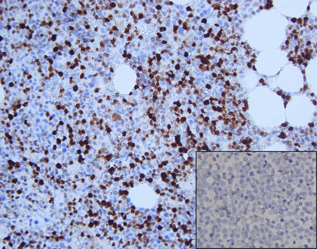 . Neoplastic cells demonstrating partial TdT positivity (400x, insert showing loss of TdT expression on neoplastic cells in relapse specimen)