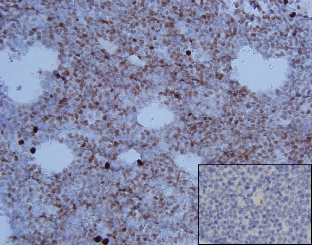 Neoplastic cells demonstrating partial MUM1 positivity (400x, insert showing loss of MUM1 expression on neoplastic cells in relapse specimen)