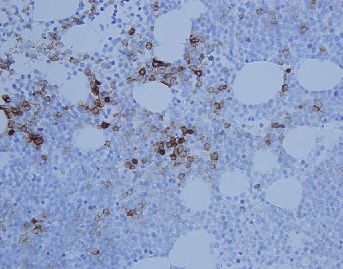 Small subset of neoplastic cells demonstrating CD20 positivity in relapsed specimen (400x)