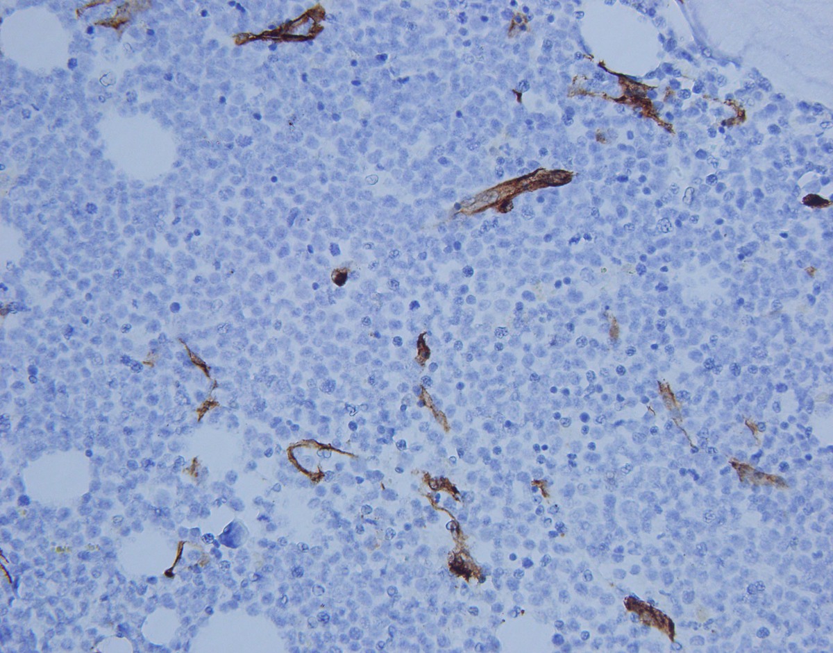 CD34 immunostain highlights vessels with CD34 negative neoplastic cells in background (400x)