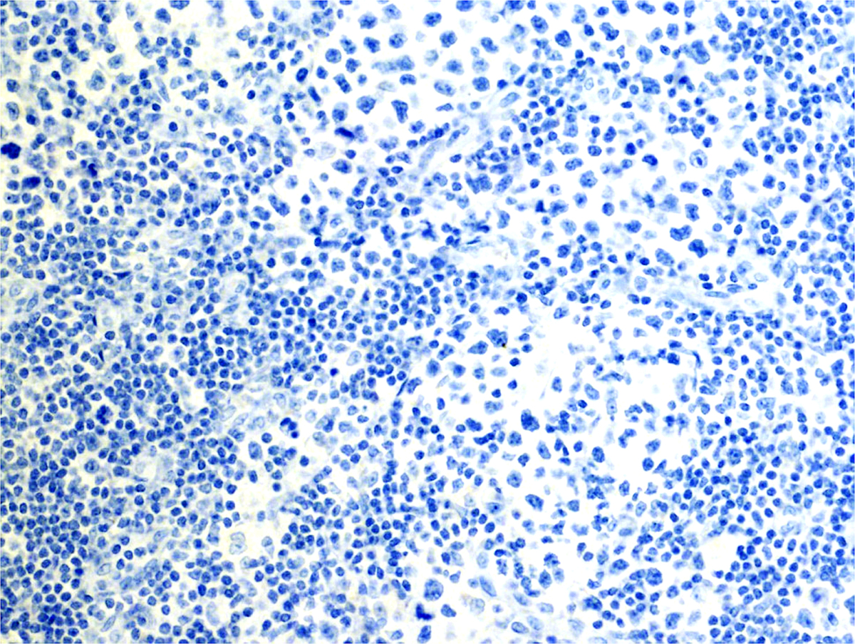 CD138, 20x: CD138 is negative in the atypical cells.
