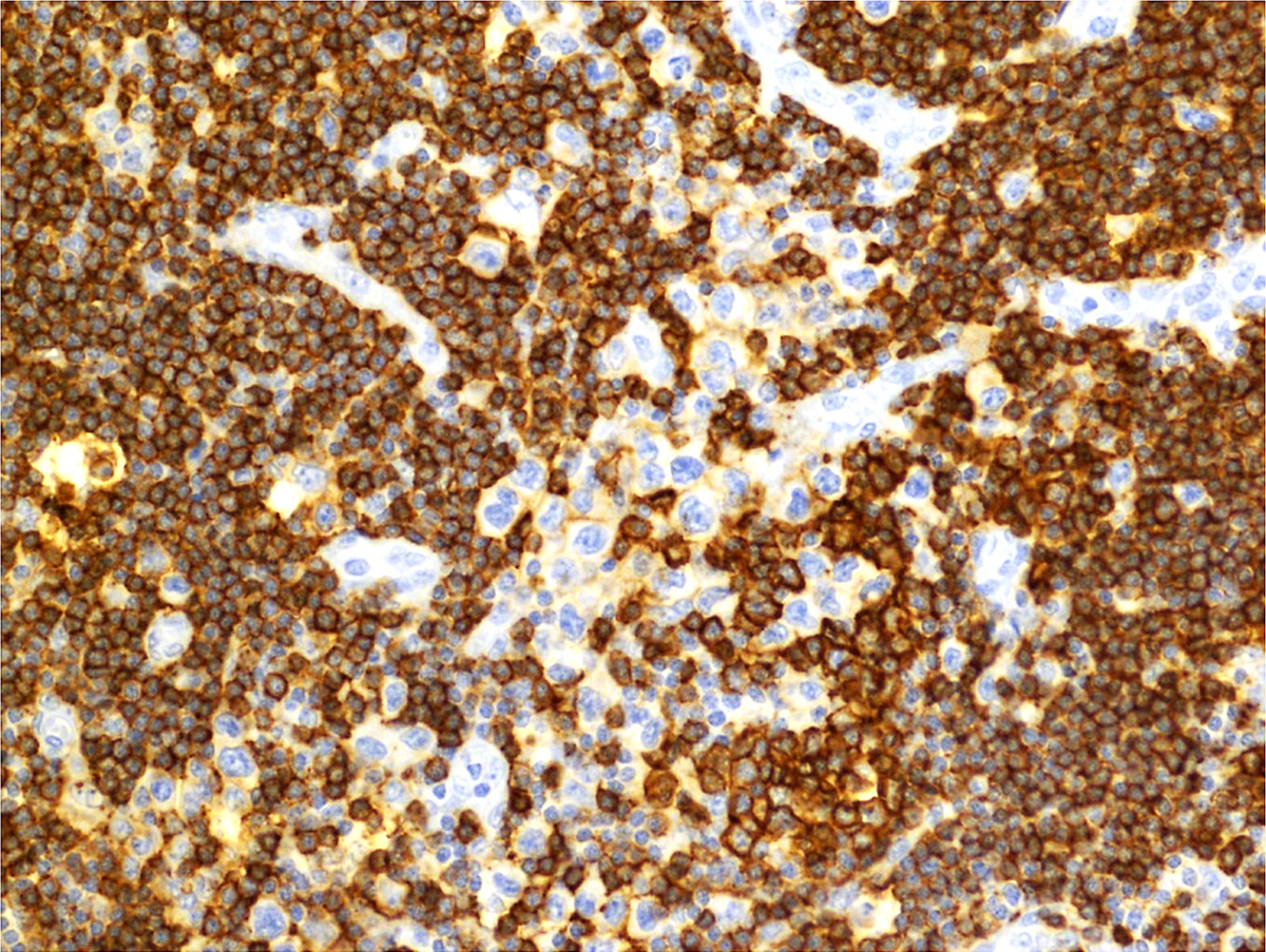 CD20, 20x: The atypical cells are dimly positive for CD20.