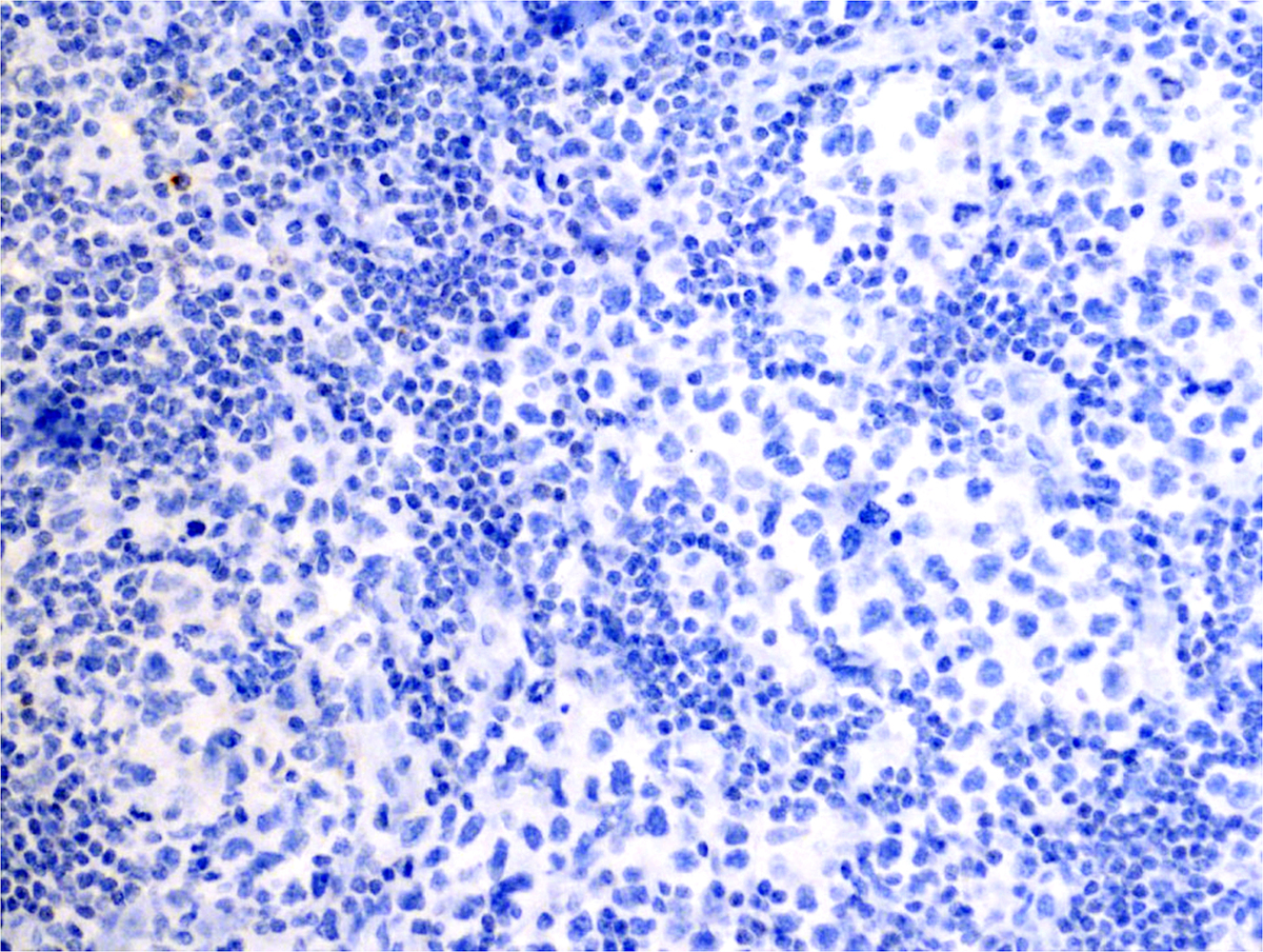 CD30, 20x: CD30 is negative in the atypical cells.