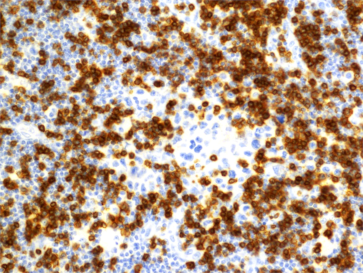 CD3, 20x: The atypical cells are negative for CD3.