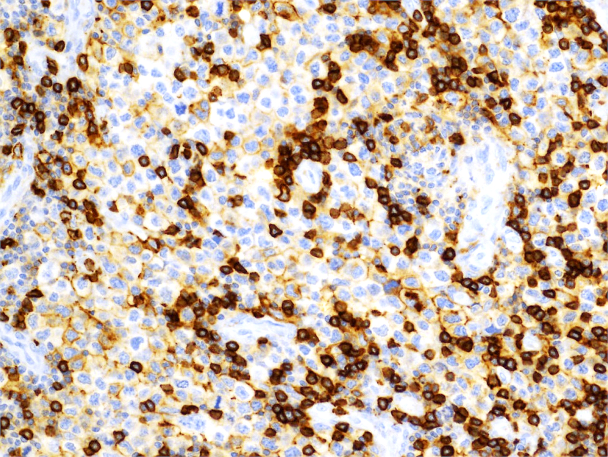 CD43, 20x: The atypical cells are largely negative for CD43.