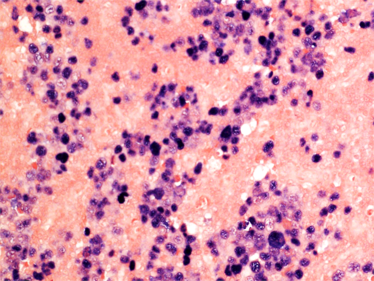 EBER-ISH, 20x: The atypical cells are uniformly positive for EBV (by EBER-ISH).
