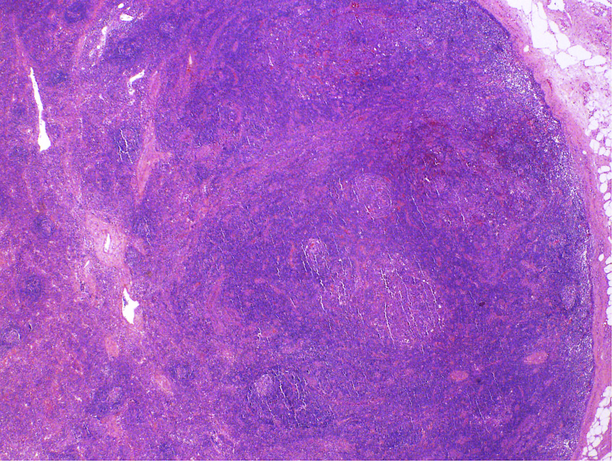 Right parotid tail lymph node, excisional biopsy, H&E, 2x: H&E sections show that the overall lymph node architecture is intact. Interfollicular zones harbor some prominent vessels.
