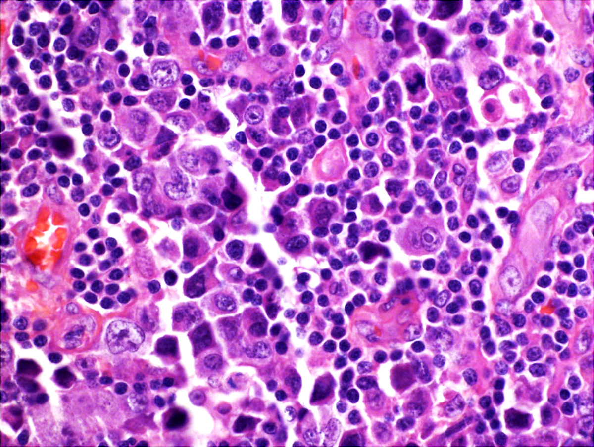 Right parotid tail lymph node, excisional biopsy, H&E, 40x: Some of the atypical cells have bizarre nuclear features including multilobation and intranuclear inclusions.