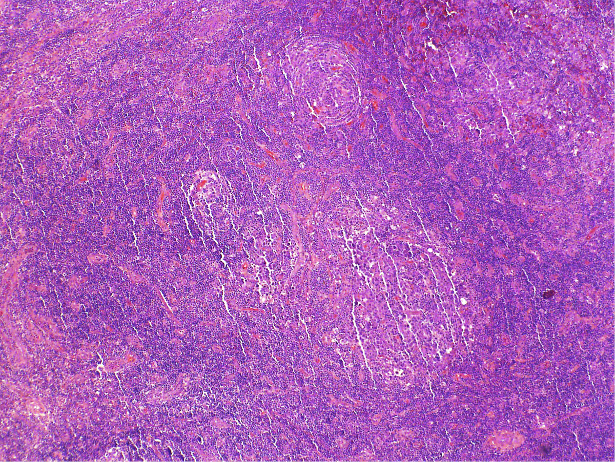 Right parotid tail lymph node, excisional biopsy, H&E, 4x: Scattered germinal centers appear expanded, while others are somewhat atrophic. Well-developed features of Castleman disease are not identified.