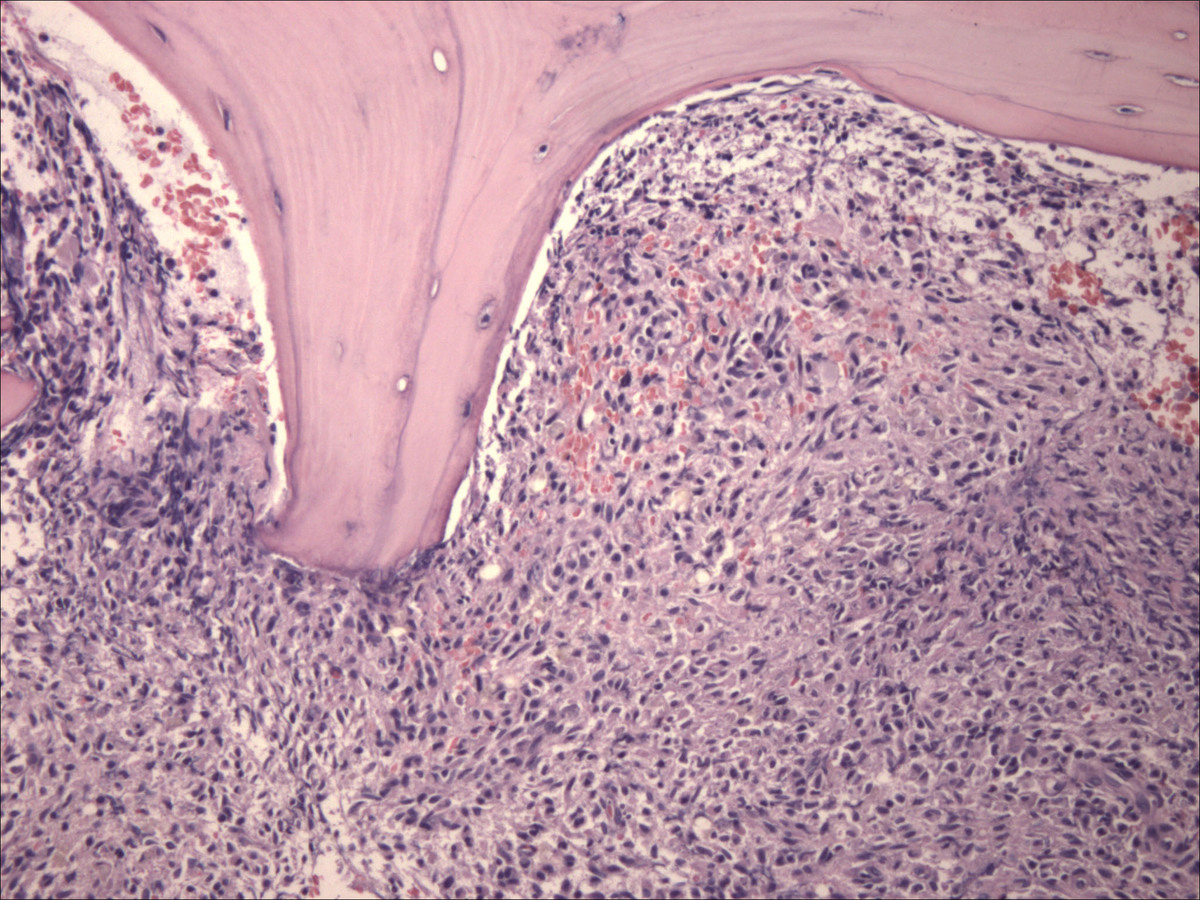 Bone marrow biopsy with extensive infiltrate of neoplastic mast cells (hematoxylin and eosin, 100x)