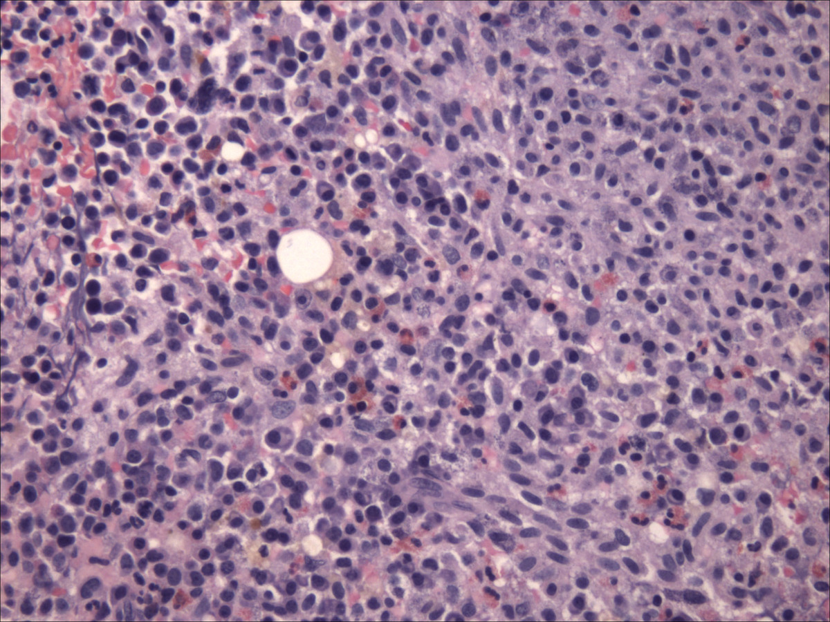 Bone marrow aspirate clot preparation showing infiltrate of atypical mast cells (hematoxylin and eosin, 200x)
