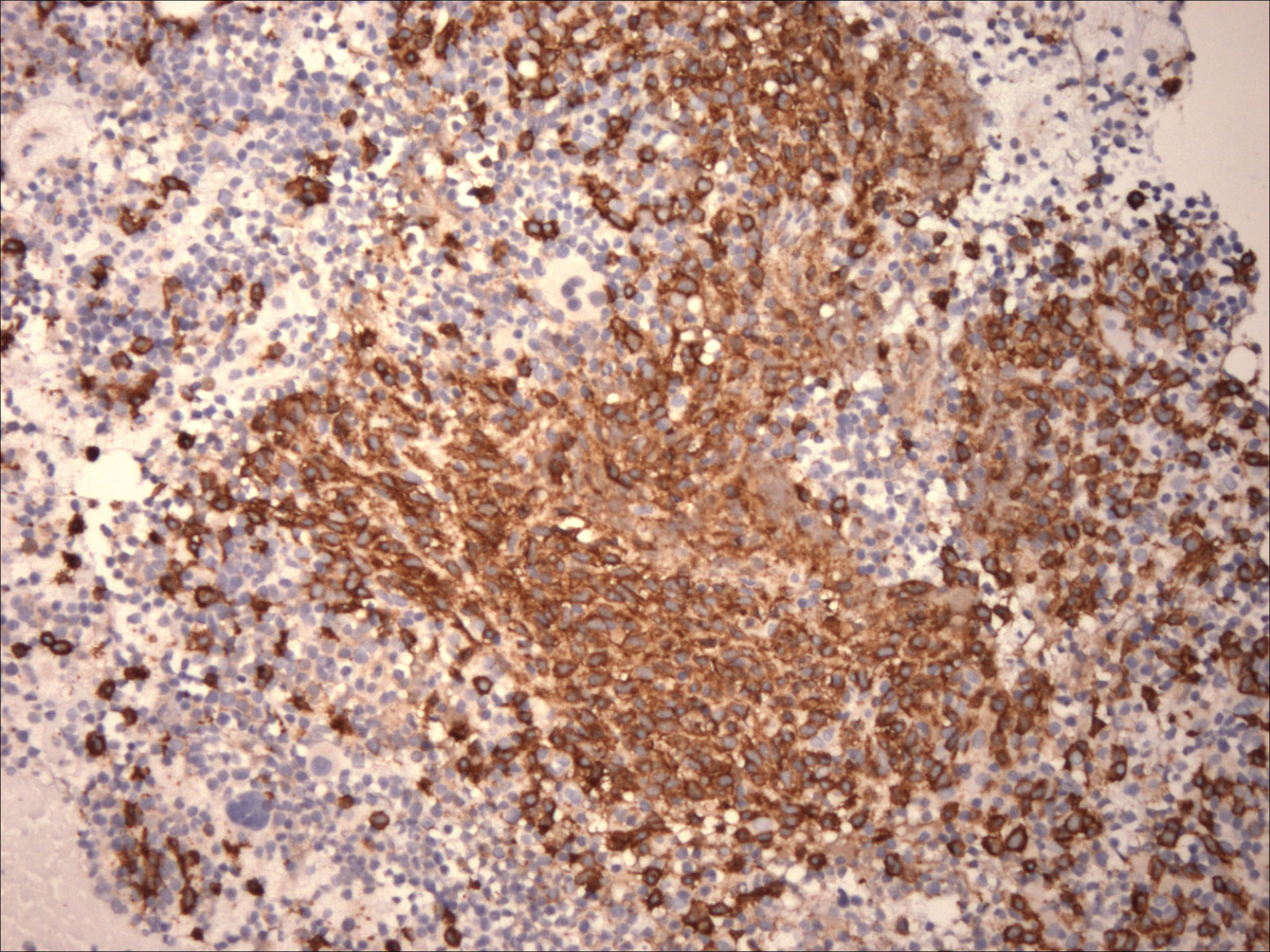 Neoplastic mast cells demonstrating CD117 positivity in bone marrow aspirate clot preparation (100x)