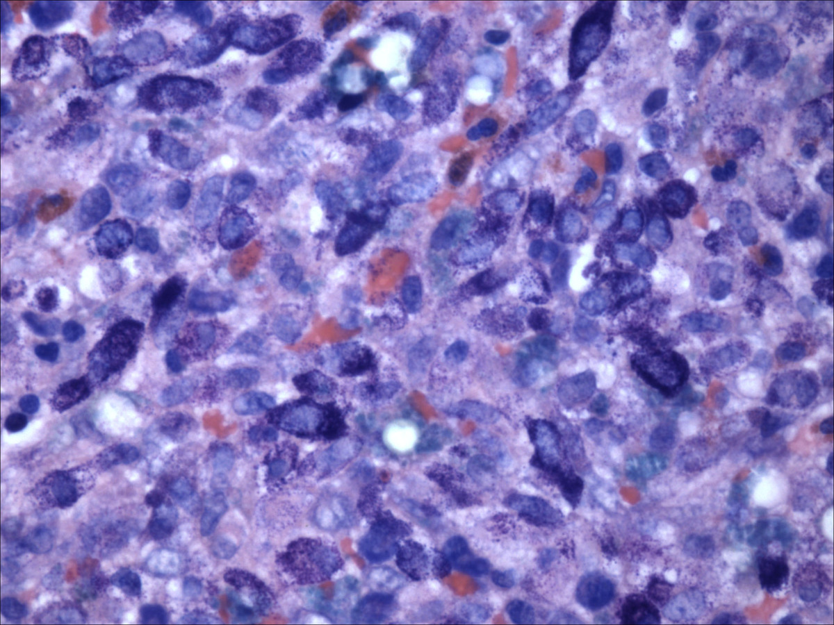Bone marrow aspirate clot preparation highlighting infiltrate of atypical mast cells (Giemsa, 400x)