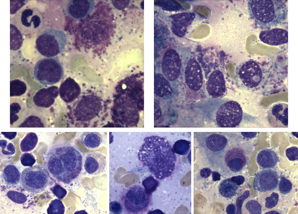 Bone marrow aspirate smear showing spectrum of atypical mast cell morphologies including promastocytes and metachromatic blasts (Wright-Giemsa, 1000x)