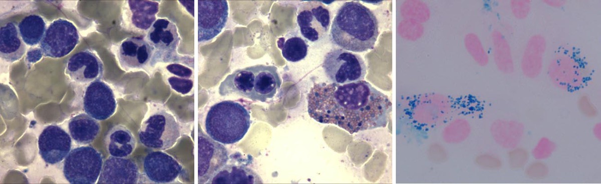 Bone marrow aspirate smear showing multilineage dysplasia and presence of numerous ring sideroblasts (Wright-Giemsa and Iron stain, 1000x)