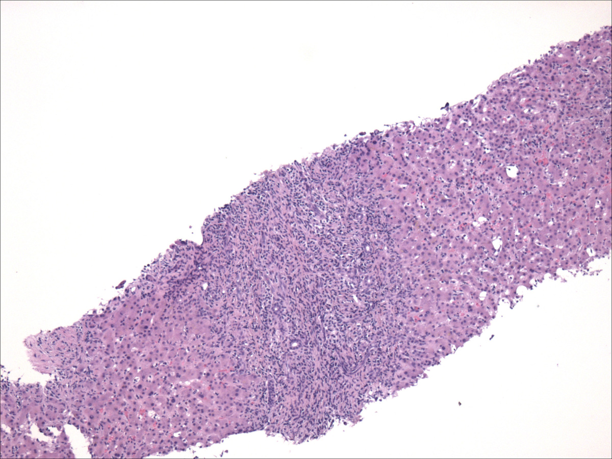 Liver biopsy with extensive infiltrate by neoplastic mast cells (hematoxylin and eosin, 40x)