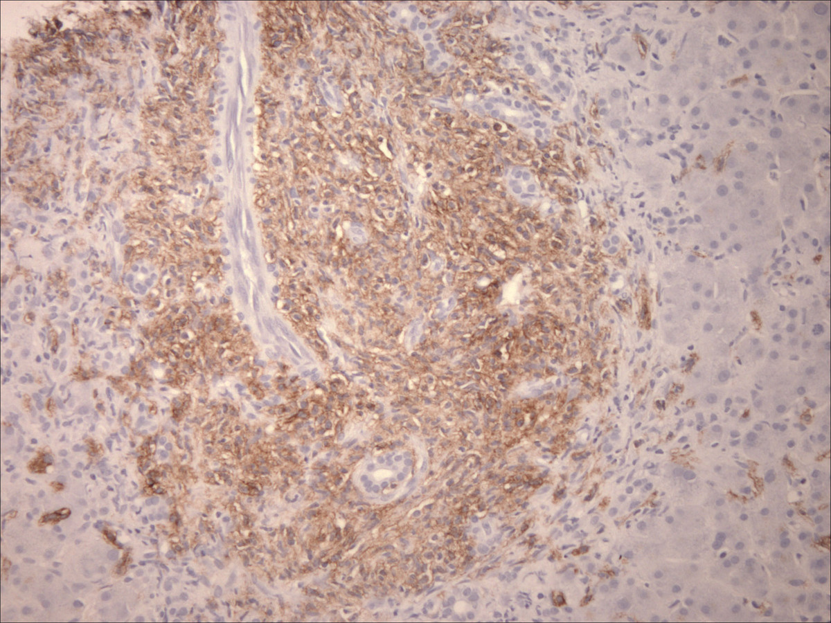 Liver biopsy: Neoplastic cells demonstrating CD117 positivity (100x)