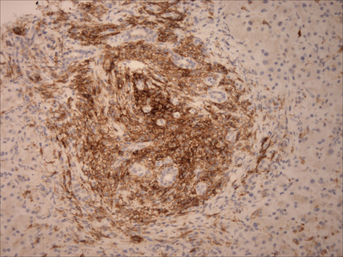 Liver biopsy: Neoplastic cells demonstrating CD25 positivity (100x)