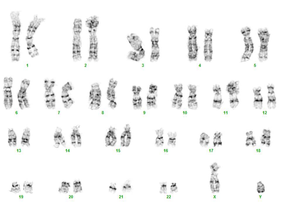 Bone marrow aspirate, 2 years post CART-19 therapy, cytogenetics: Cytogenetics performed on the bone marrow aspirate obtained 2 years post CART-19 therapy shows a normal male karyotype 46,XY[25]. FISH confirmed the absence of TP53.
