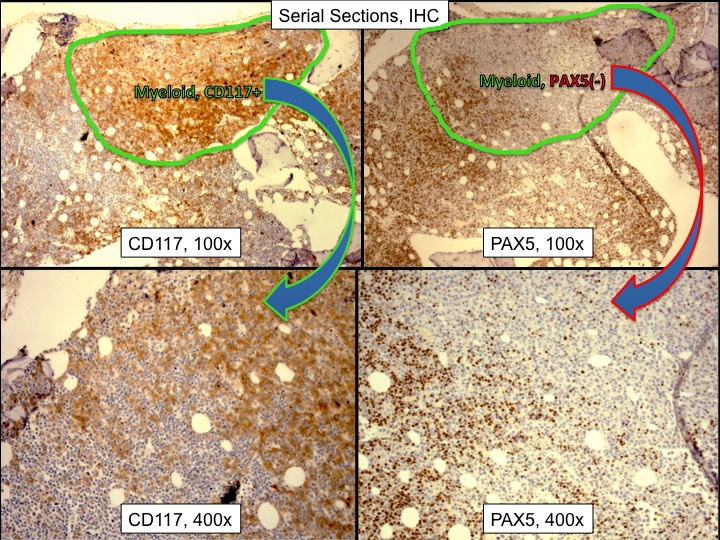 Some areas were composed mainly of large blasts with abundant cytoplasm. They expressed CD117 and MPO, but not lymphoid antigens.