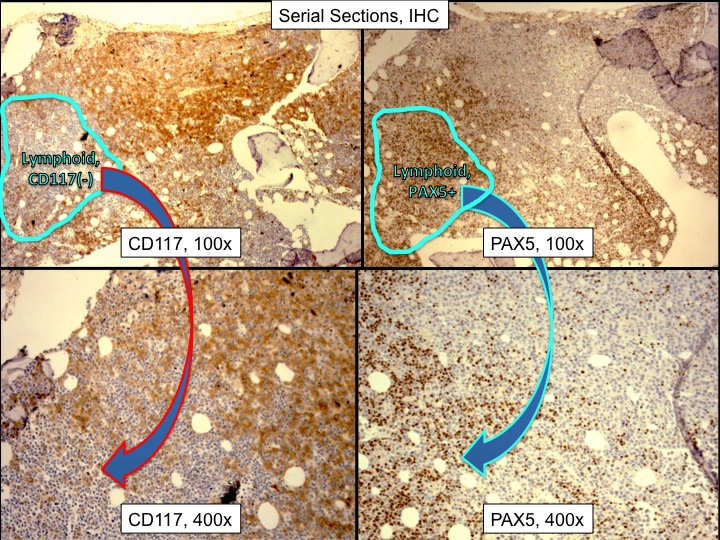 Other areas were composed mainly of small blasts with scant cytoplasm. They expressed B cell antigens, including PAX5, CD79a and CD20. They did not express CD117 or MPO.