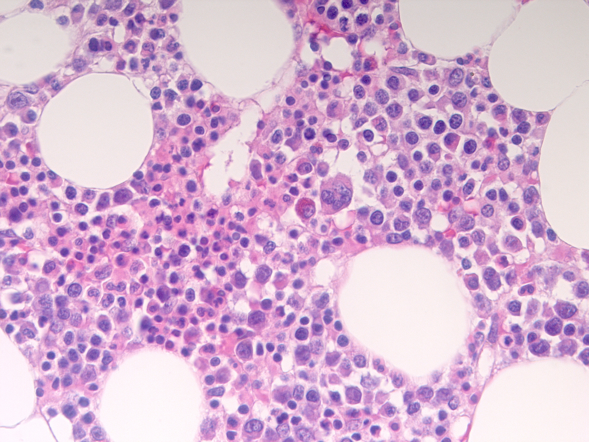 Bone marrow biopsy showing less frequent areas of left shifted myeloid precursors and a few scattered eosinophils (40x)