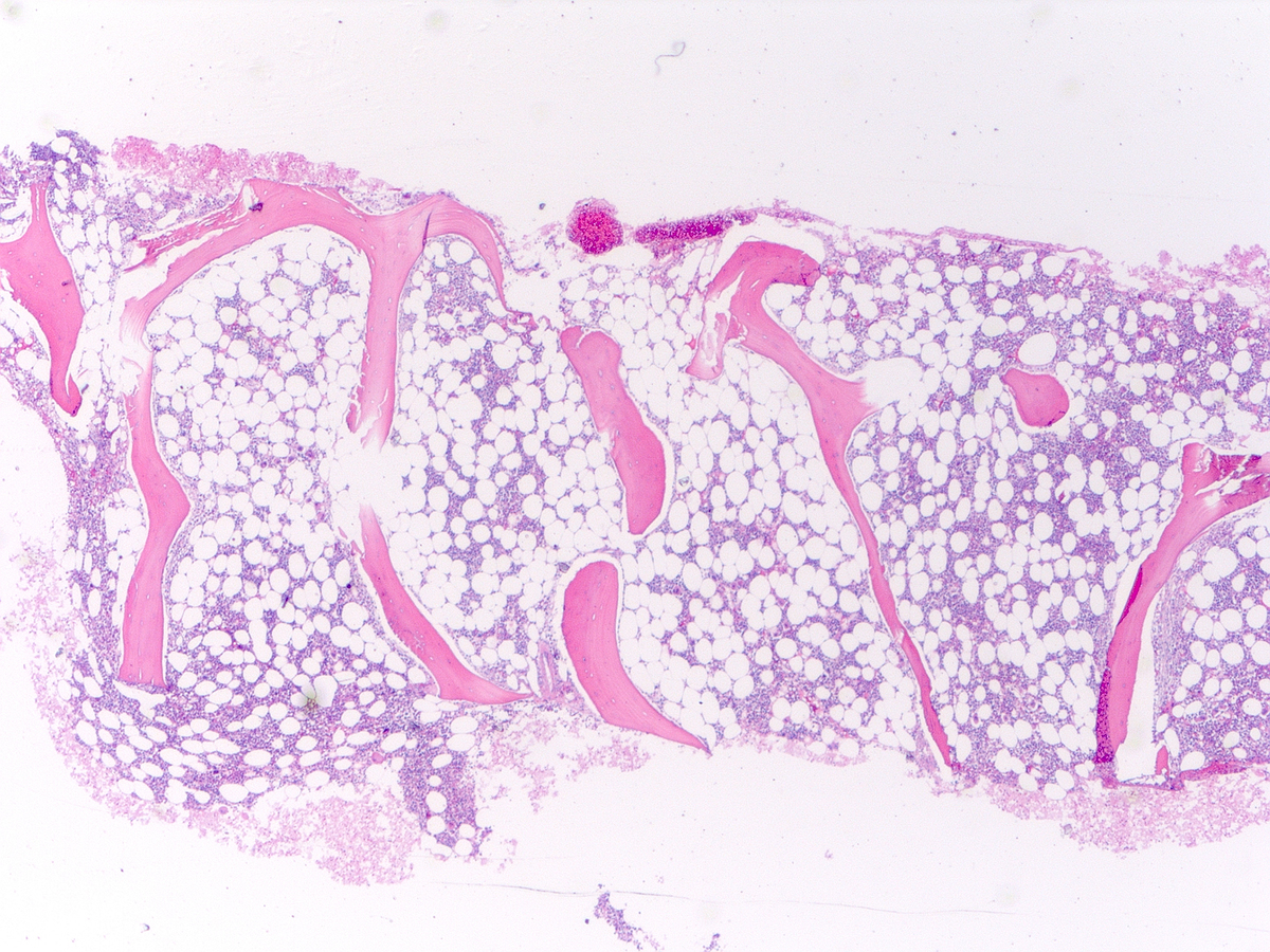 Overview of normocellular (~40%) bone marrow biopsy (2.5x)