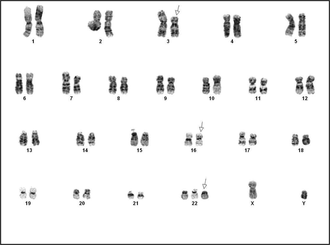 Karyotype: 47,XY,add(3)(p21),inv(16)(p13q22),+22[3]/46,XY[14] 