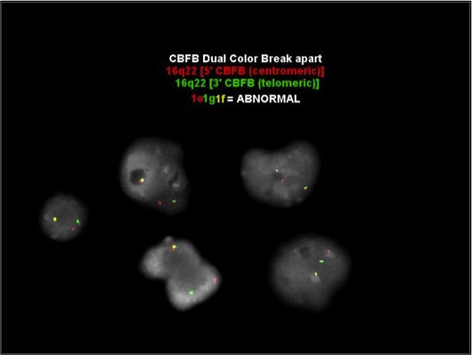 FISH: Low level positive result for CBFB gene rearrangement; Nuc ish(CBFBx2)(5’CBFB sep 3’CBFBx1)[7/500]