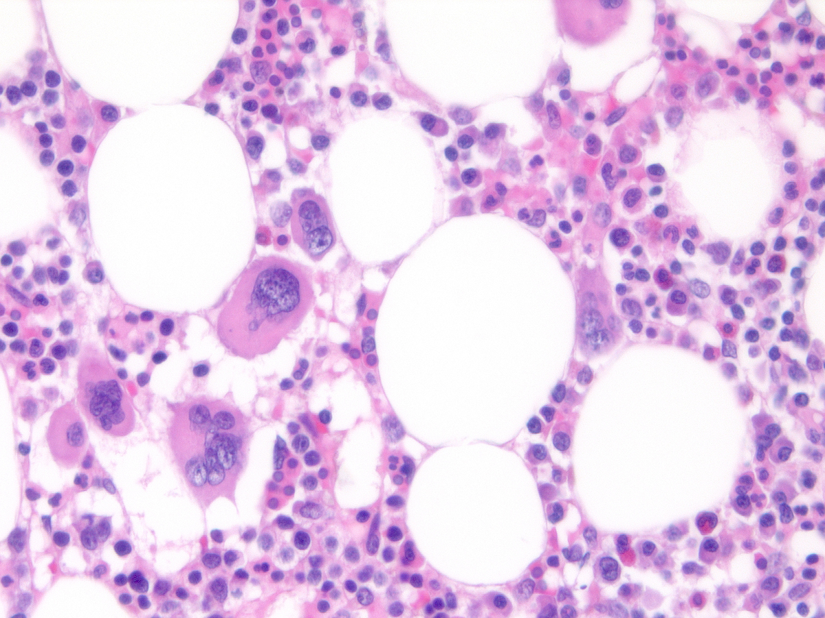 Bone marrow biopsy showing predominant areas of normal myeloid maturation (40x)