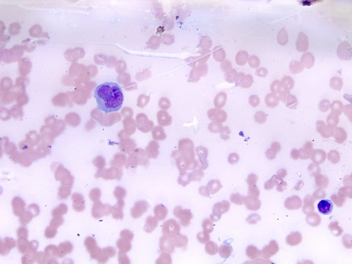 Rare (1-2%) abnormal monocyte seen on hemodilute aspirate smear (50x)