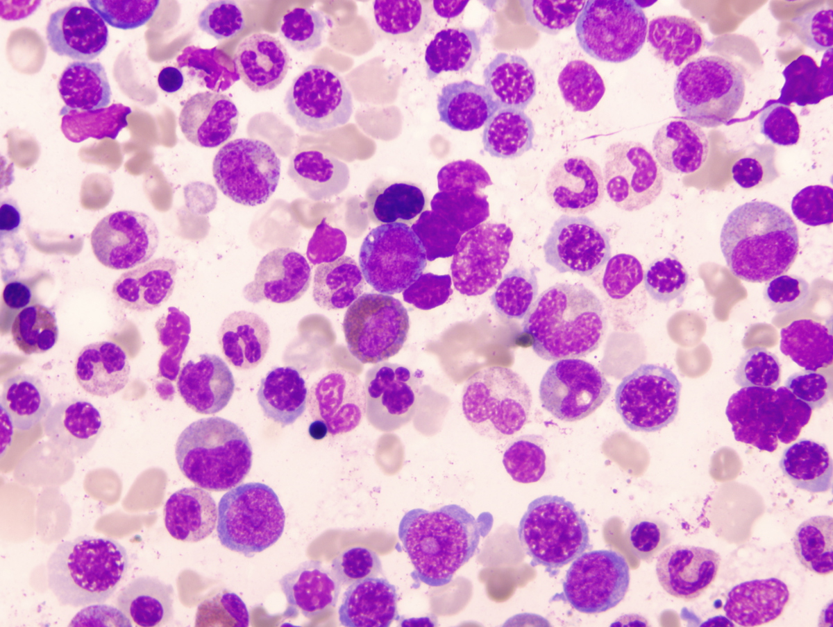 Bone marrow aspirate