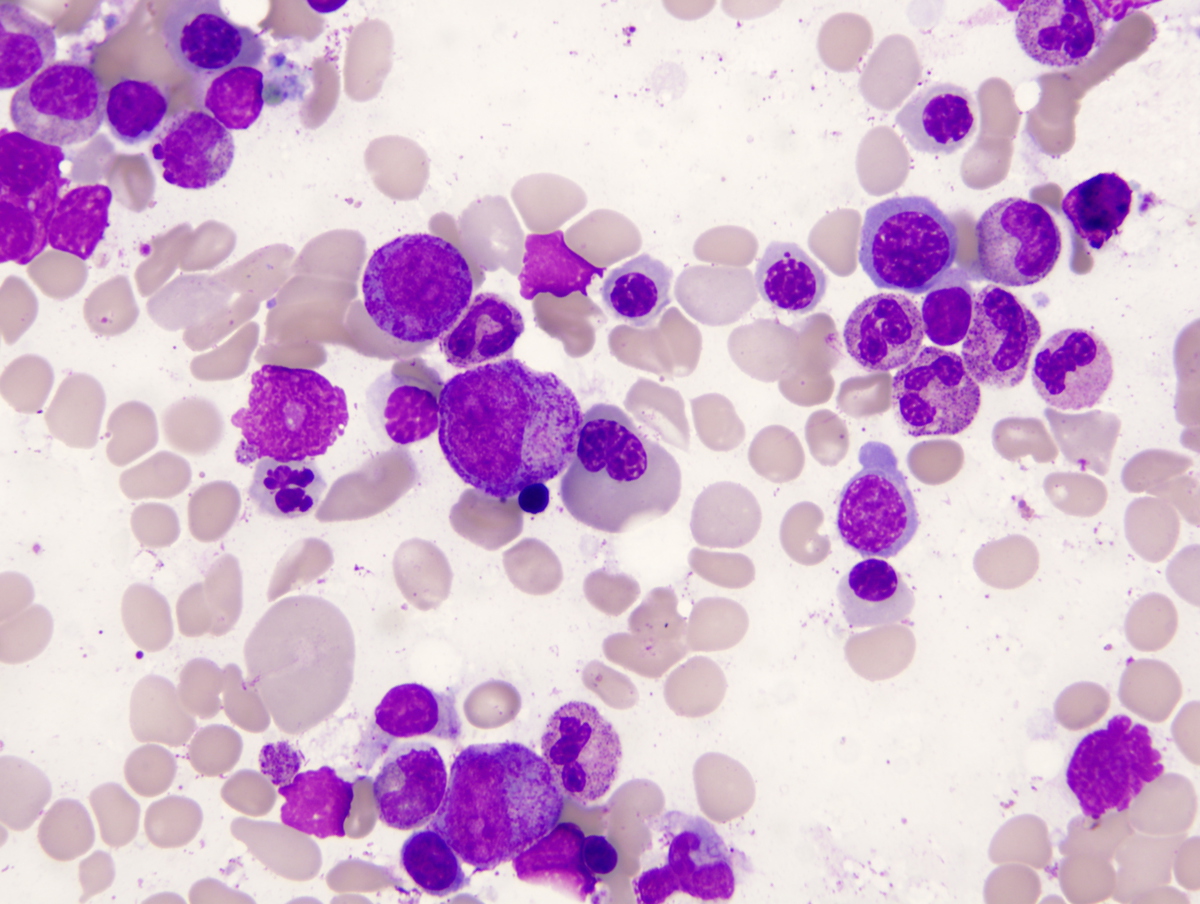 Bone marrow aspirate