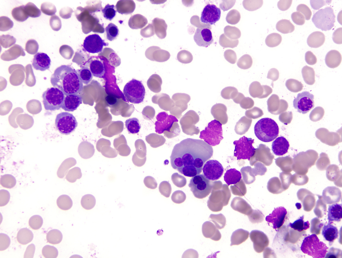 Bone marrow aspirate