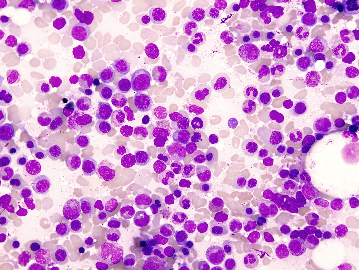 Bone marrow aspirate low