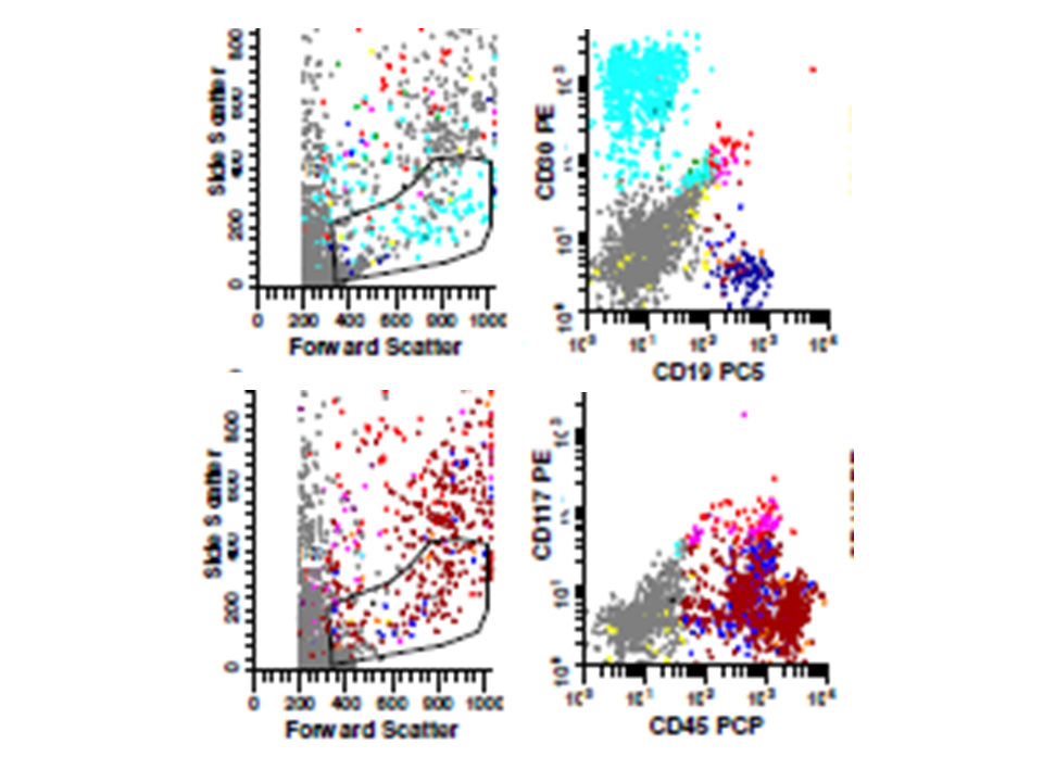 Flow cytometry -neoplastic cells painted light blue (upper panels ) and red (lower panels)