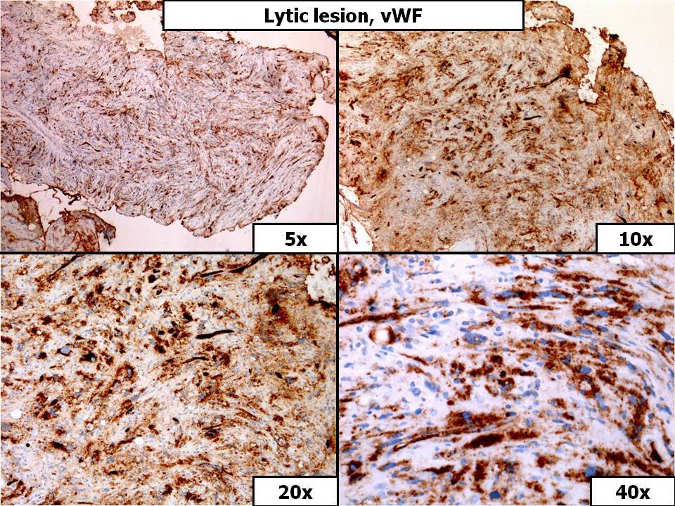 Lytic Lesion, vWF