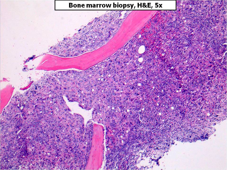 Bone Marrow Biopsy, H&E, 5x