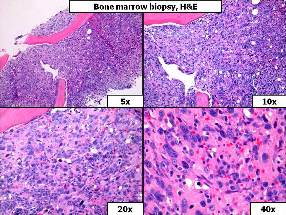 Bone Marrow Biopsy, H&E
