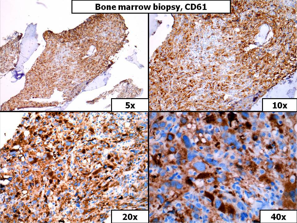 Bone Marrow Biopsy, CD61