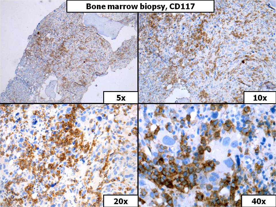 Bone Marrow Biopsy, CD117