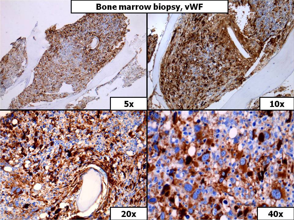 Bone Marrow Biopsy, vWF