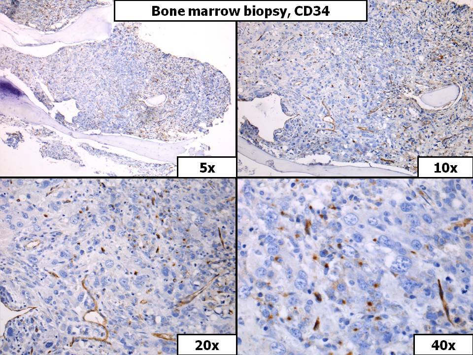 Bone Marrow Biopsy, CD34