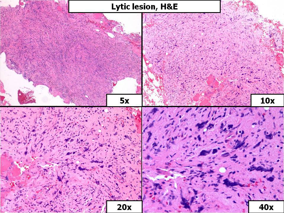 Lytic Lesion, H&E