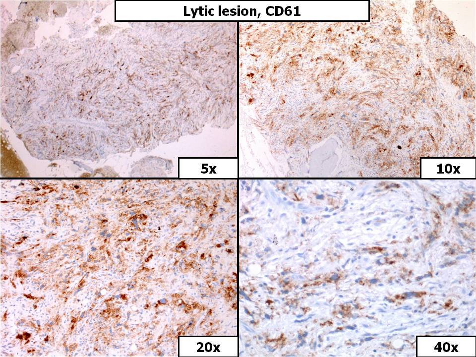 Lytic Lesion, CD61