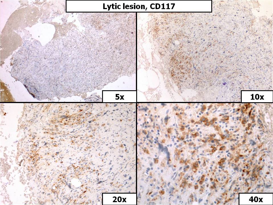Lytic Lesion, CD117