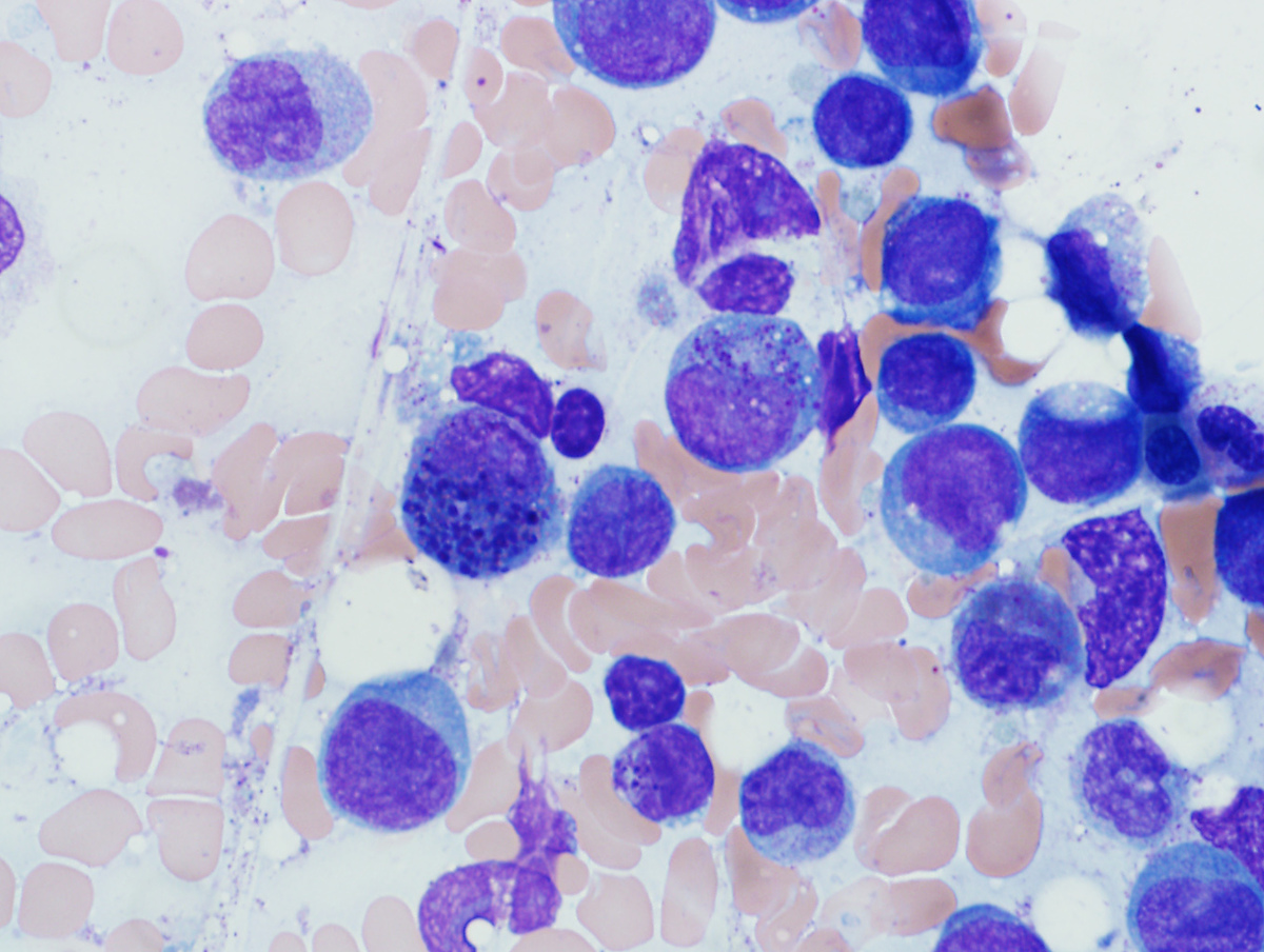 Bone marrow aspirate smear, Wright-Giemsa, 100x, abnormal eosinophil precursor with large basophilic granules